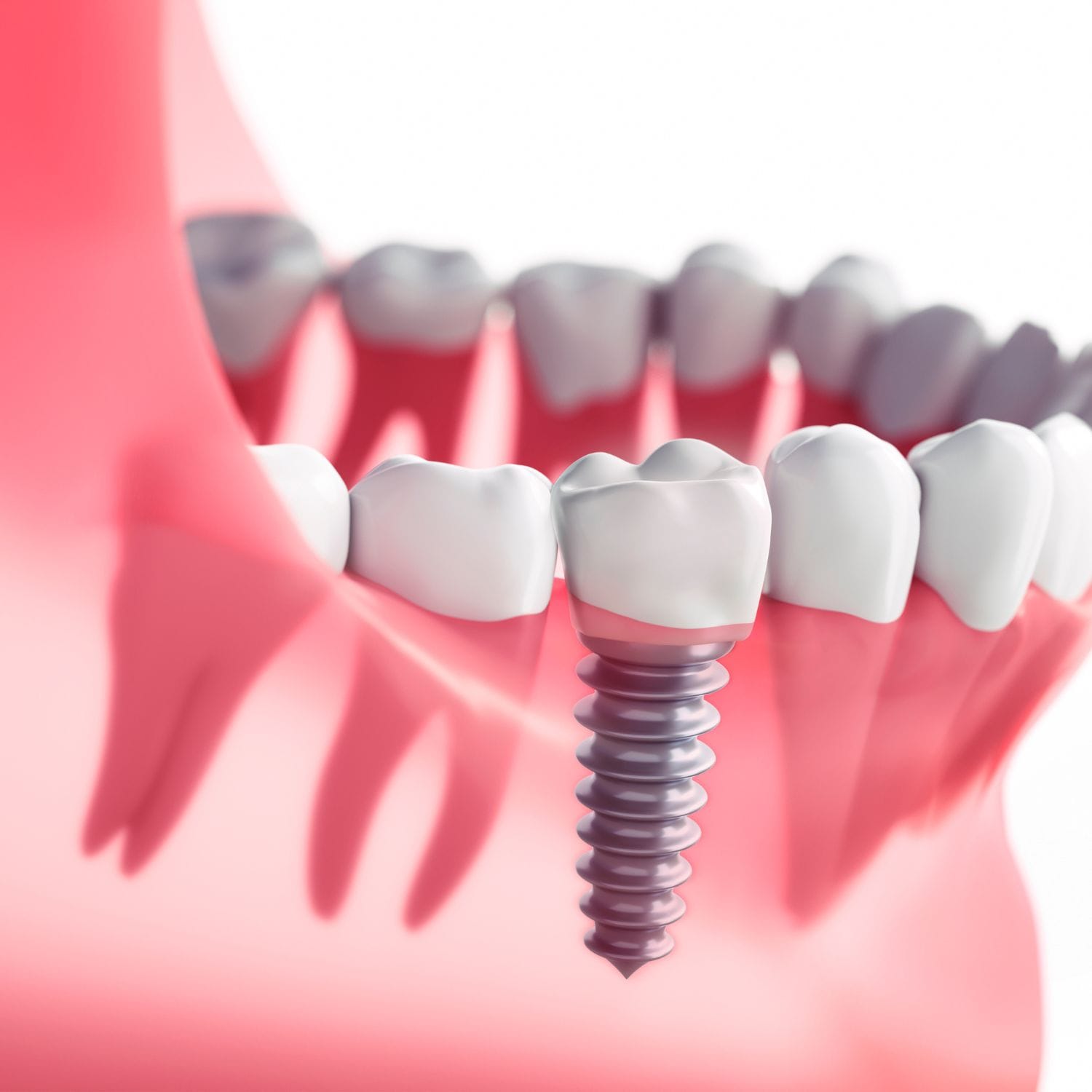 Dentista professionista che mostra un modello di protesi dentale